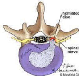 فیلم آموزشی بیرون زدگی دیسک ستون فقرات