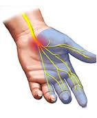 متلازمة النفق الرسغي فيديو للتدريب