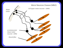 بیماریهای نرون حرکتی و ALS