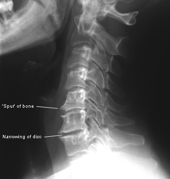 عکس رادیولوژی , عکس گردن , دیسک گردن