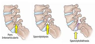 اسپوندیلولیستزیس, جابجایی مهره های کمر , لغزندگی مهره های کمر