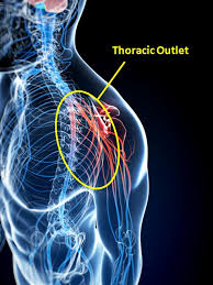 TOS , thoracic outlet syndrome , دنده گردنی , درد گردن , گردن درد