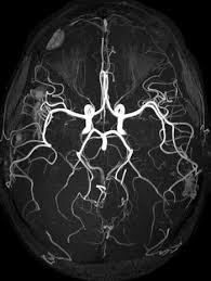 ام آر آی عروق مغز, ام آر ا , ام آر آی رگ