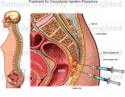 درمان درد دنبالچه, تزریق در دنبالچه, coccyx injection