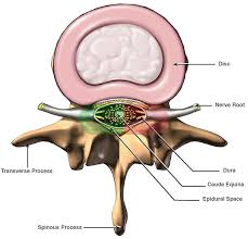 دیسک کمر, کمر درد , فتق دیسک , سیاتیک