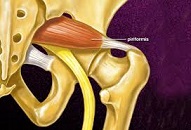 فیلم آموزشی درگیری عصب سیاتیک بدلیل سندروم پریفورمیس