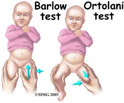 ortolani test, Barlow test,تست نوزادان , تست ارتولانی , تست بارلو, معاینه نوزاد