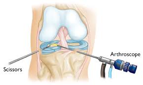 آرتروسکوپی زانو ,آرتروسکوپی منیسک زانو