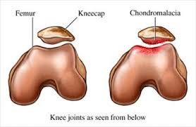 کندرومالاسی یا نرمی کشکک